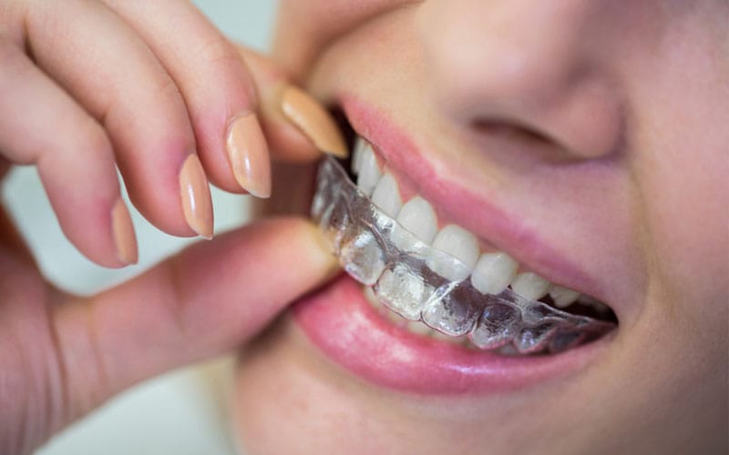 Orthodontic Treatment Advances