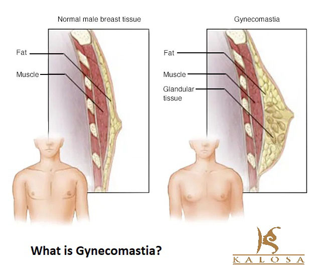 what is gynecomastia