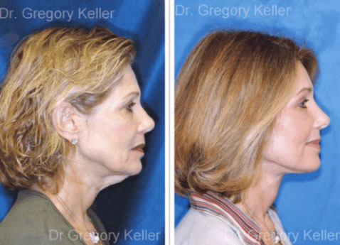 Enhancing Woman's Facial Beauty with Facelift