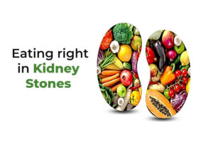 eating right foods in kidney stones